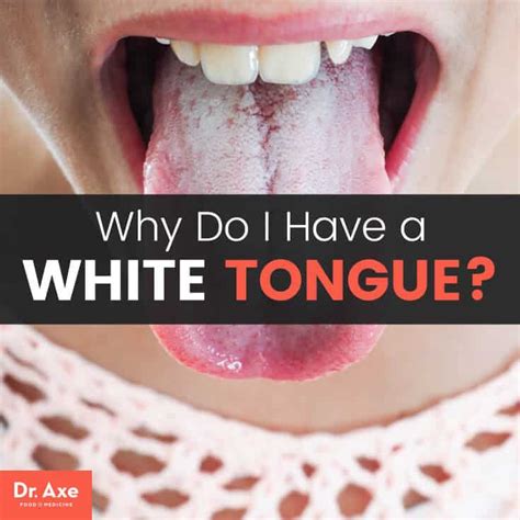 White Tongue Causes & 10 Natural Treatments for White Tongue - Dr. Axe