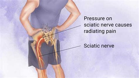 Chiropractic and Sciatica - Black Chiropractic