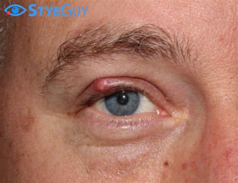 Common Stye | StyeGuy | Quickly Treating The Common Stye