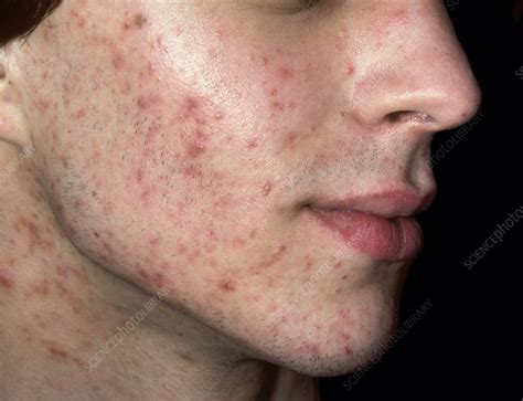 Acne vulgaris - Stock Image - C038/4485 - Science Photo Library