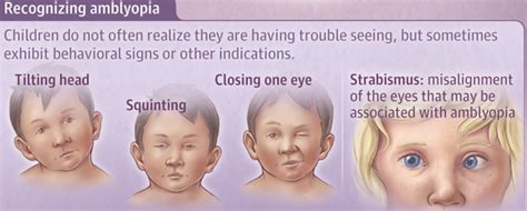 Visual vertigo and amblyopia