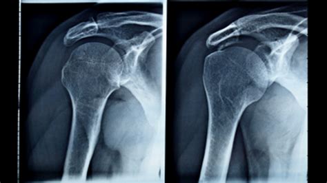 What is Shoulder Arthritis - Orthopedic Surgery | Health Choices First