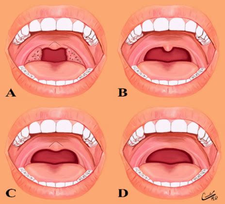 The Uvula: Conditions that Dental Hygienists can Observe during an Exam ...