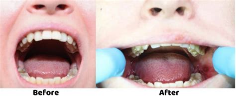 wisdom teeth removal no stitches - fiscus-mezquita