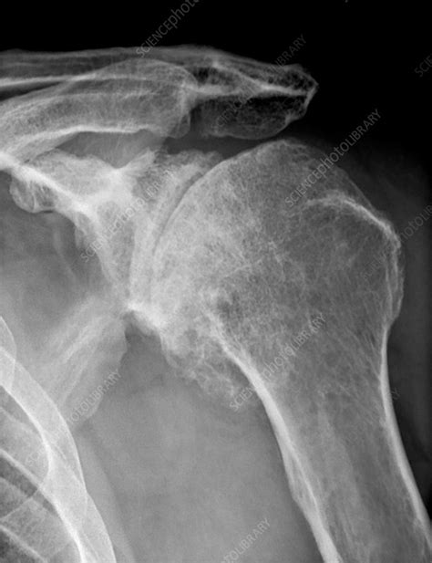 Osteoarthritis of the shoulder, X-ray - Stock Image - C037/2762 ...