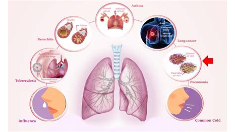 Respiratory Diseases