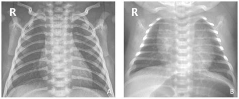 (A) Representative chest X-ray of a normal, non-infected neonate. (B ...