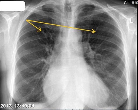 Pulmonary Edema X Ray Butterfly Pattern