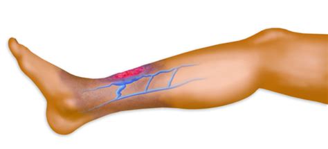 Performance Vein Institute of Los Alamitos: Chronic Venous ...