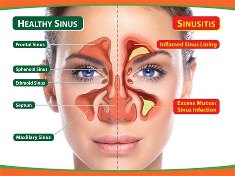 Sinus infection causes, symptoms and natural treatments for sinusitis