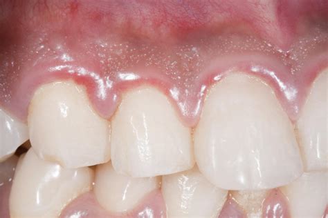 Swollen gums: Causes, treatments, and home remedies