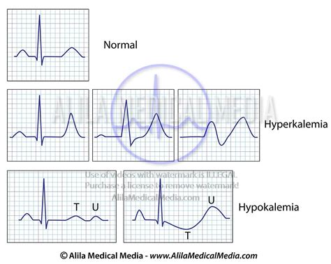 Hyperkalemia And Hypokalemia Ecg Changes | Images and Photos finder