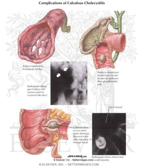 Complications of Cholecystitis