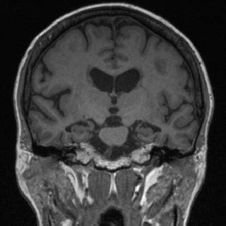 Medial temporal lobe atrophy | Image | Radiopaedia.org