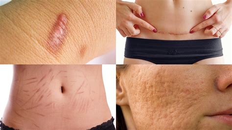 Scar Removal in Niddrie | Laser Scar Treatment | O’Laze