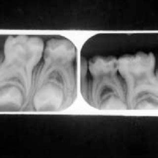 Taurodontism classified as Hypo, Mesio and Hyper type | Download ...