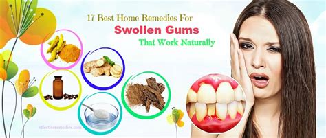 17 Best Home Remedies For Swollen Gums That Work Naturally