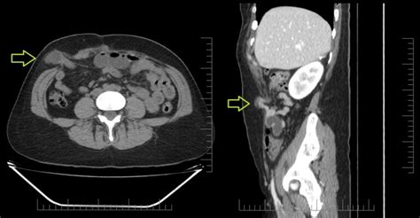 HERNIA DE SPIEGEL archivos - Diagnostico911.org