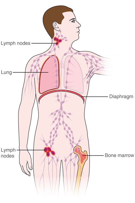 Lymphoma: Symptoms, Causes, And Treatments, 52% OFF