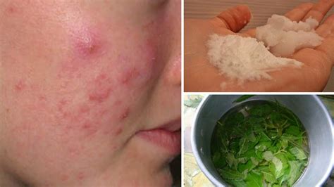 7 Cystic Acne Home Remedies that Really Work - YouTube