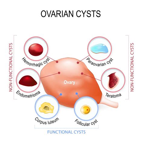 Fibroids vs. Cysts: What's the Difference? | New York City | 1 Fibroid ...