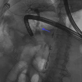 Verification of choledochoduodenostomy creation via the injection of ...