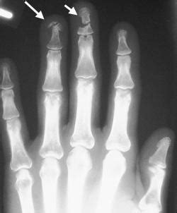 Distal Phalanx Fracture