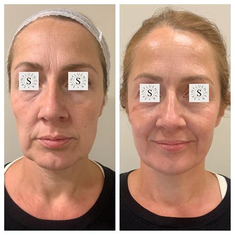 Face Tightening Laser Treatment in London | Skinfluencer