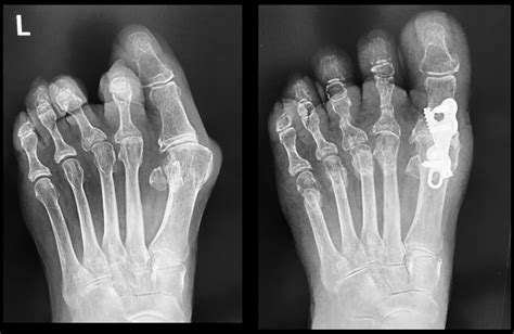 Situation agréable Serment exercises after foot fusion surgery valise ...