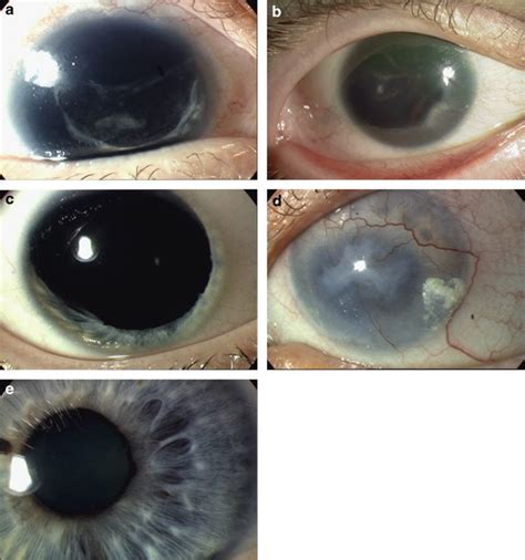 Aniridia | European Journal of Human Genetics