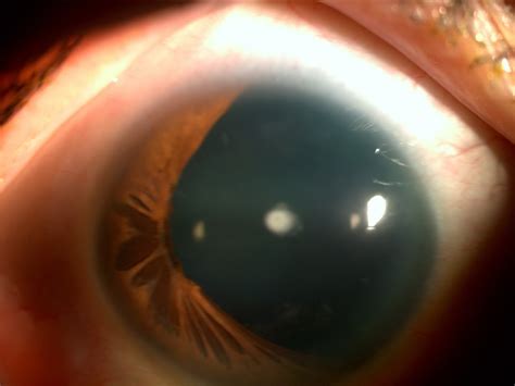 Aniridia 1 | Hereditary Ocular Diseases