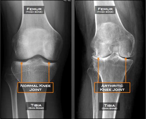 Knee Arthritis Austin, TX | Knee Osteoarthritis Austin, TX | Cedar Park