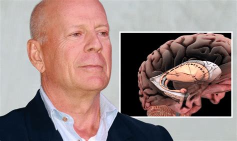 Bruce Willis: Doctor on actor's aphasia - symptoms and causes | Express ...