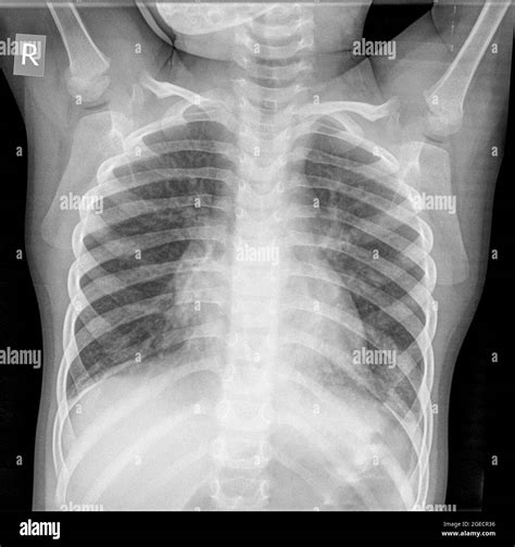 Chest x-ray of a 3 year old female infant. front view Stock Photo - Alamy