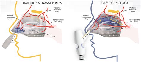 Trudhesa DHE Nasal Spray: Top 7 Reasons to Consider DHE for Migraine ...