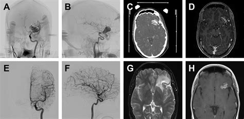 Brain Arteriovenous Malformations | Radiology Key