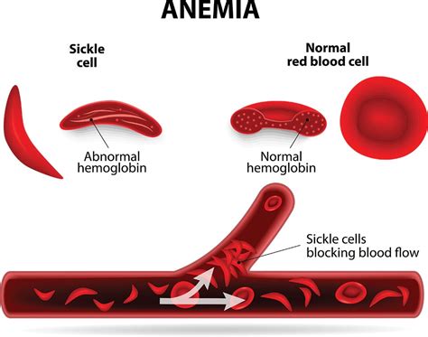 Sickle Cell Anemia - Nature's Way Medicine | Marijuana Treatment