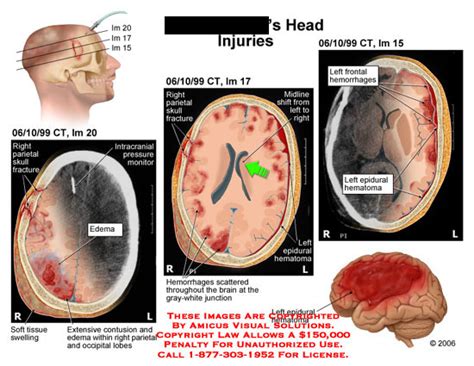 AMICUS Illustration of amicus,injury,head,brain,hematoma,bleeding,bleed ...