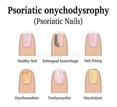 Nail Psoriasis: Symptoms, Causes & Treatments – NailDesignCode