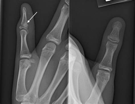 THUMB DISTAL PHALANX PEDIATRIC FRACTURE | Hand Surgery Source