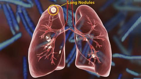 Lung Nodules Treatment In Delhi | Dr. Arvind Kumar