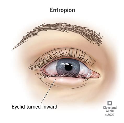 What Is Entropion Surgery