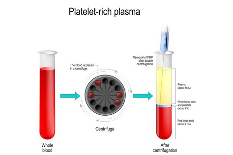 PRP Injections Vs. Cortisone Shots | Spine Pain Dr MA 02379