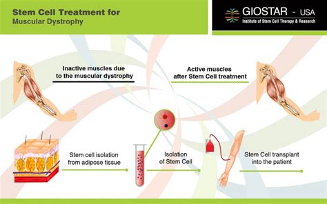 Muscular Dystrophy Treatment in India, Stem Cell Therapy for Muscular ...