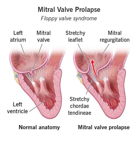 mitral valve prolapse repair life expectancy - Niesha Velez