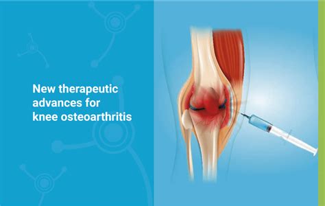 New therapeutic advances for knee osteoarthritis - Arthrosis Clinic