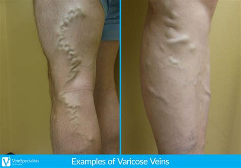 Causes of Varicose Veins Tampa FL | Vein Care Specialists