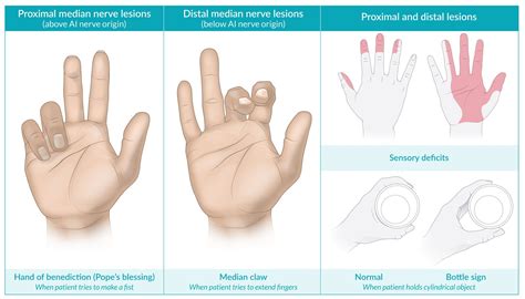 Median Nerve Palsy