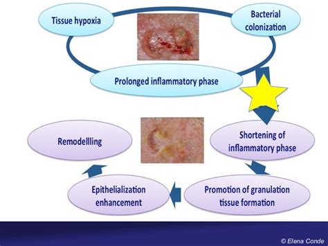 Platelet Rich Plasma in wound healing - Elena Conde