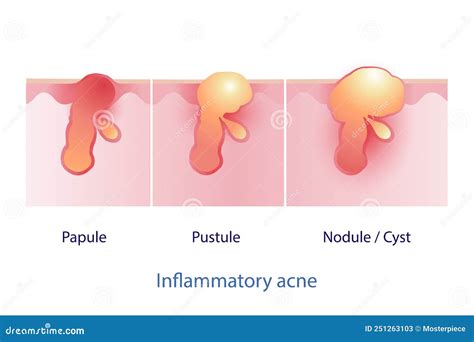 Acne Nodule Vs Cyst